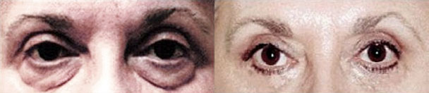 Eyelid Surgery BEFORE AND AFTER PHOTOS : female, frontal view - patient 1, Closter, NJ