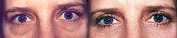 Eyelid Surgery BEFORE AND AFTER PHOTOS : female, frontal view - patient 2, Closter, NJ