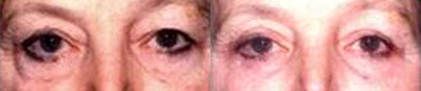 Eyelid Surgery BEFORE AND AFTER PHOTOS : female, frontal view - patient 3, Closter, NJ