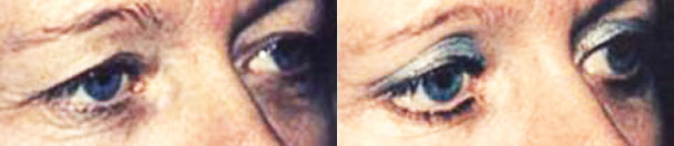 Eyelid Surgery BEFORE AND AFTER PHOTOS : female, frontal view - patient 4, Closter, NJ