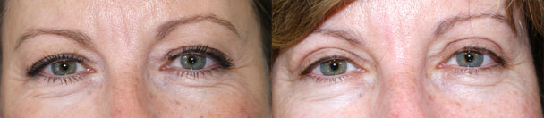 Eyelid Surgery BEFORE AND AFTER PHOTOS : female, frontal view - patient 5, Closter, NJ