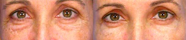 Eyelid Surgery BEFORE AND AFTER PHOTOS : female, frontal view - patient 6, Closter, NJ