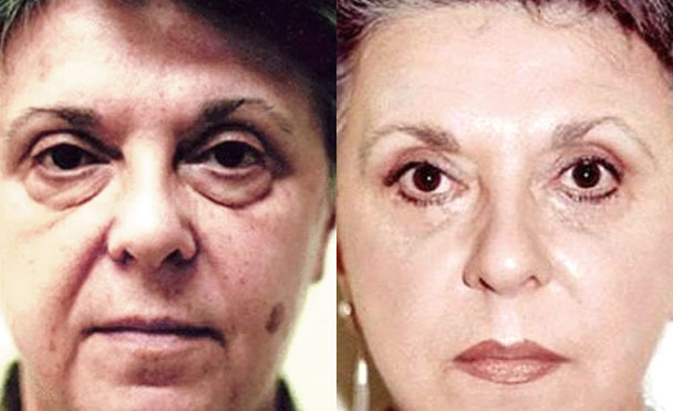 FACELIFT BEFORE and AFTER PHOTOS - female patient 10 (front view)