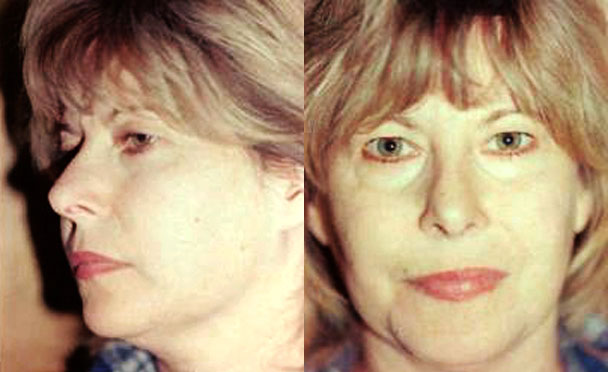 FACELIFT BEFORE PHOTO - female patient 2 (front view)