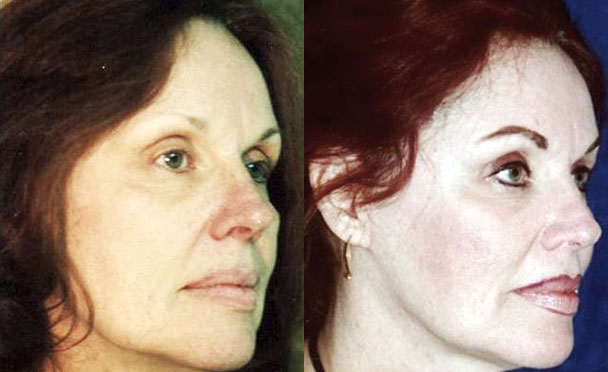 FACELIFT BEFORE and AFTER PHOTOS - female patient 3 (oblique view)