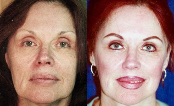 FACELIFT BEFORE and AFTER PHOTOS - female patient 3 (front view)