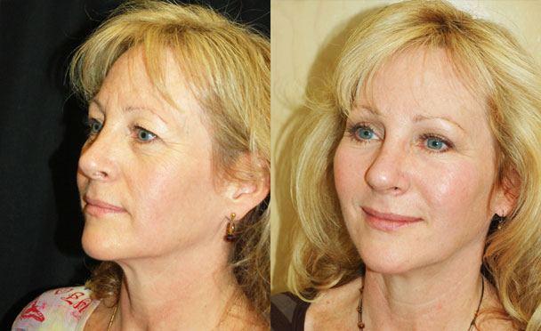 FACELIFT BEFORE and AFTER PHOTOS - female patient 4 (oblique view)