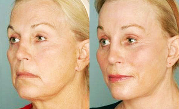 FACELIFT BEFORE and AFTER PHOTOS - female patient 5 (oblique view)