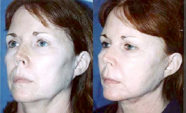 FACELIFT BEFORE and AFTER PHOTOS - female patient 6 (oblique view)