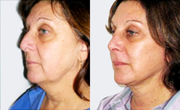 FACELIFT BEFORE and AFTER PHOTOS - female patient 7 (oblique view)