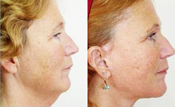 FACELIFT BEFORE and AFTER PHOTOS - female patient 8 (right side view)