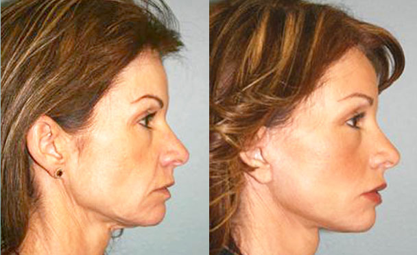 FACELIFT BEFORE AND AFTER PHOTOS - female patient 1 (right side view)