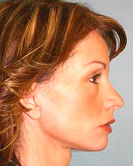 patient after Facelift Procedure