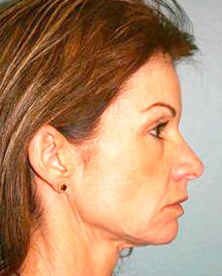 patient before Facelift Procedure