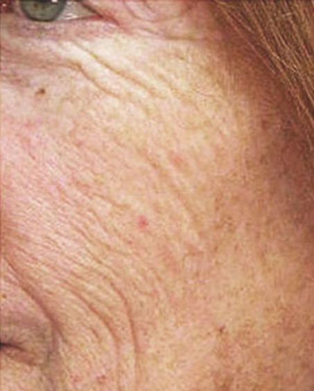 patient before Laser Resurfacing