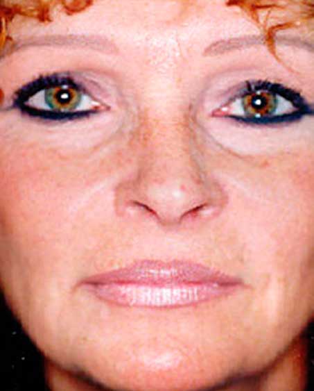 patient after Liquid Facelift Procedure