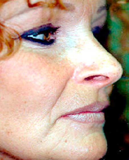 patient before Liquid Facelift Procedure