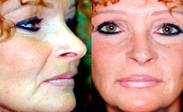 Anti-wrinkle injections - Before and After Photos - female patient 3