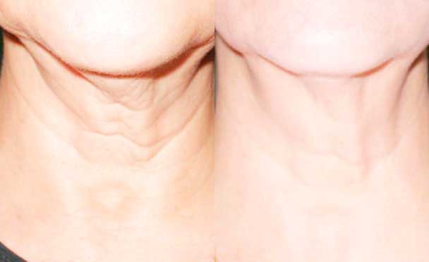 Anti-wrinkle injections - Before and After Photos - female patient 4 (neck)