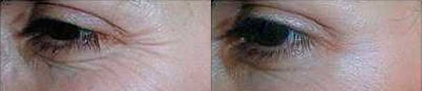 Anti-wrinkle injections - Before and After Photos - female patient 5 (eyelid)