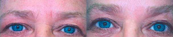 Botox - Before and After Photos - female patient 6 (brow, eyelid)