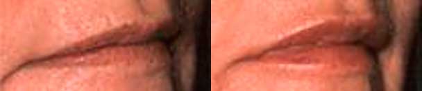 Anti-wrinkle injections - Before and After Photos - female patient 7 (lips)