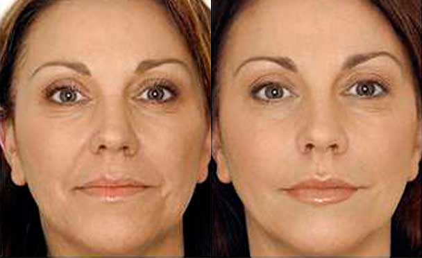 Anti-wrinkle injections - Before and After Photos - female patient 2