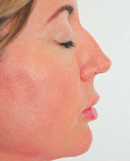 Non-Surgical Nose Job - Photo Before Treatment