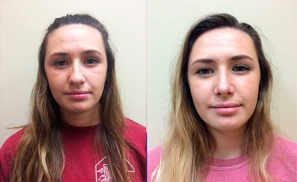 RHINOPLASTY BEFORE AND AFTER PHOTOS - Female patient 1