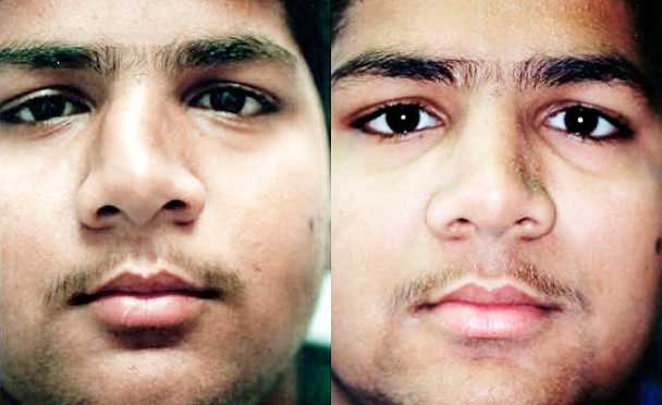 RHINOPLASTY BEFORE AND AFTER PHOTOS - Male, patient 14