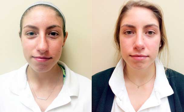 RHINOPLASTY BEFORE AND AFTER PHOTOS - Female patient 3,  Procedure in Closter