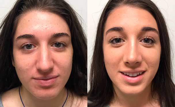 RHINOPLASTY BEFORE AND AFTER PHOTOS - Female, patient 22 (front view)