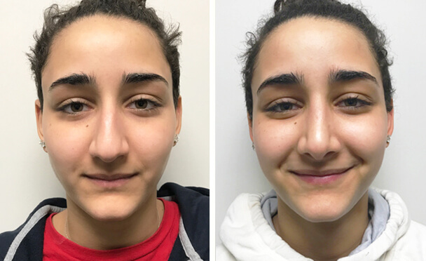 RHINOPLASTY BEFORE AND AFTER PHOTOS - Female, patient 23 (front view)