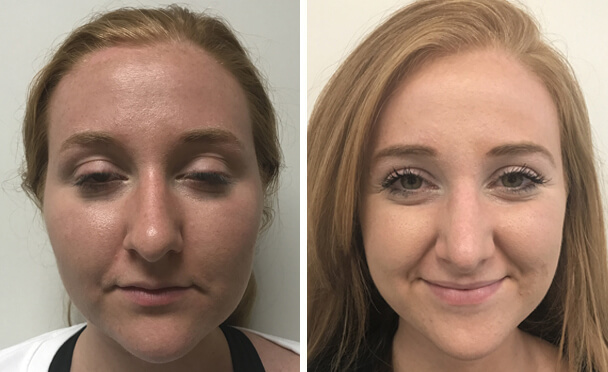 RHINOPLASTY BEFORE AND AFTER PHOTOS - Female, patient 24 (front view)